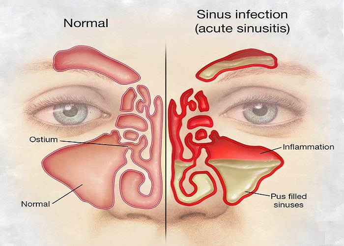 Nose Blockage Treatment by ENT Doctor in Meerut